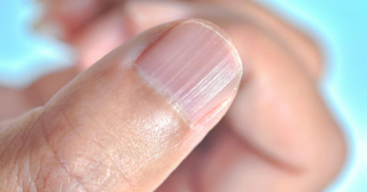 ¿Por qué me salen líneas en las uñas y qué hacer para eliminarlas?