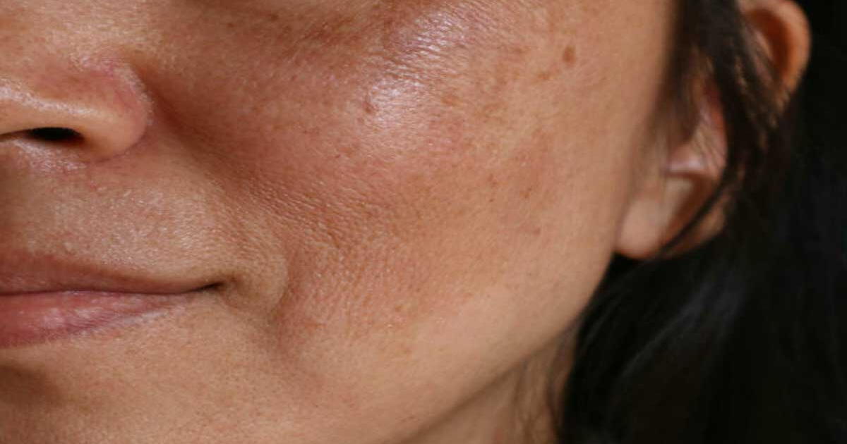 Do you want to remove facial spots? With this home remedy, you will see results in 1 week.