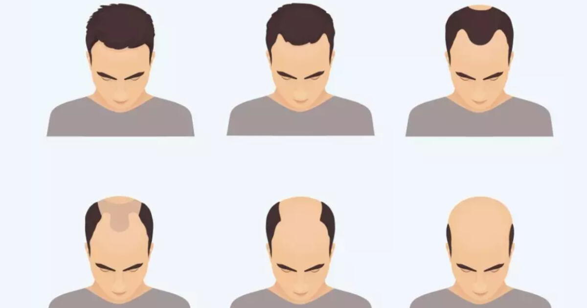 El test de personalidad que te dirá si sufrirás pérdida de cabello a temprana edad