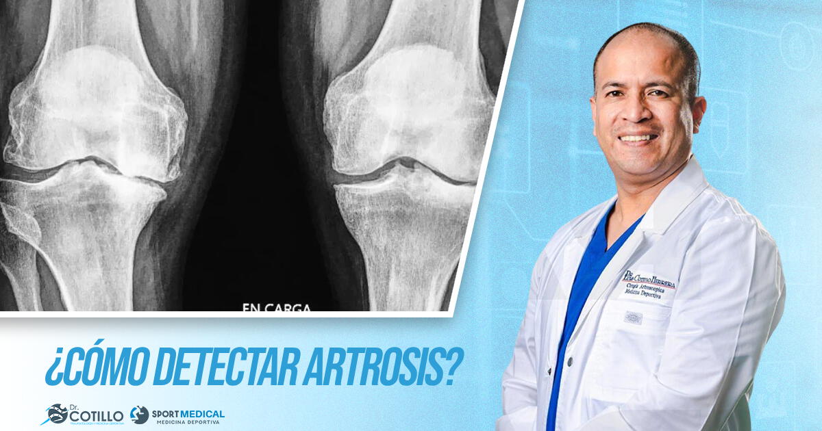 Estos son los signos para detectar la artrosis, por el Dr. Luis Cotillo