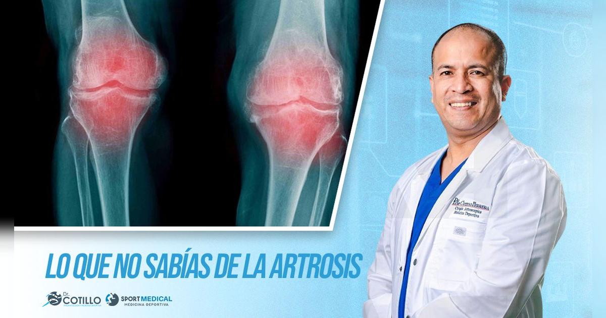 ¿Qué articulaciones son las más afectadas por la artrosis?, por el Dr. Luis Cotillo