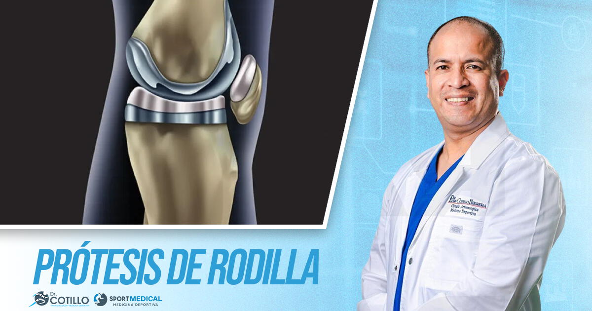¿Cuándo se recomienda una prótesis total de rodilla?, por el Dr. Luis Cotillo
