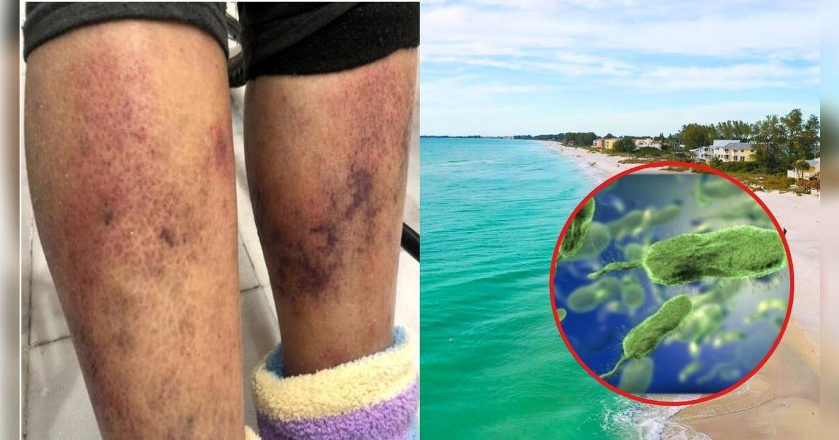 Alerta de seguridad en Florida: se reportan muertes por bacteria carnívora encontrada en aguas costeras