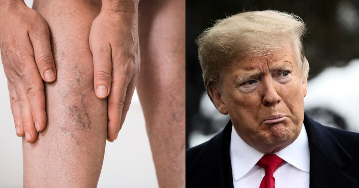 Impactante diagnóstico de Donald Trump: ¿qué es la insuficiencia venosa crónica, la peligrosa enfermedad que padece?