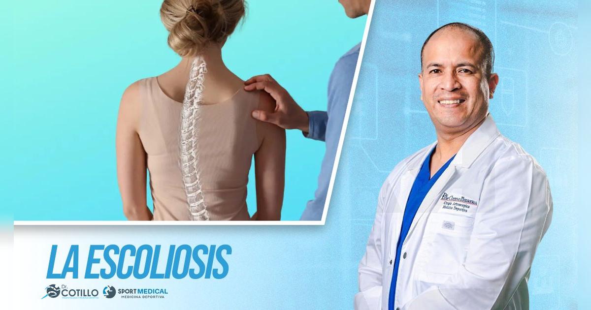 ¿Qué es la escoliosis?, por el Dr. Cotillo