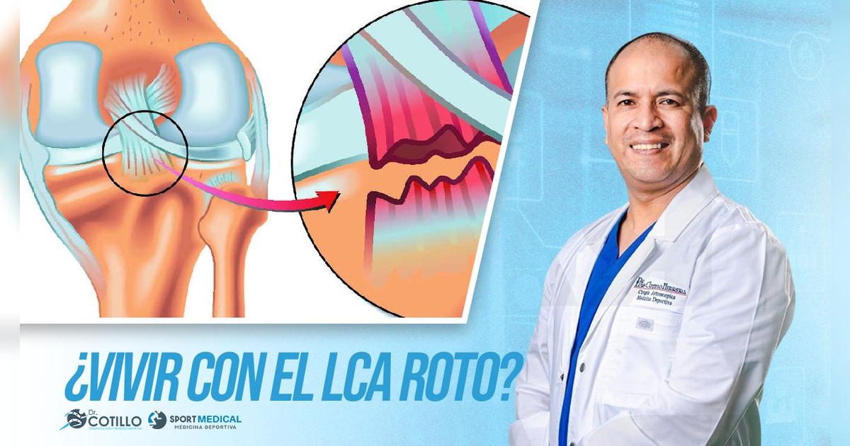 ¿Se puede vivir con el Ligamento Cruzado Anterior (LCA) roto?, por el Dr. Luis Cotillo
