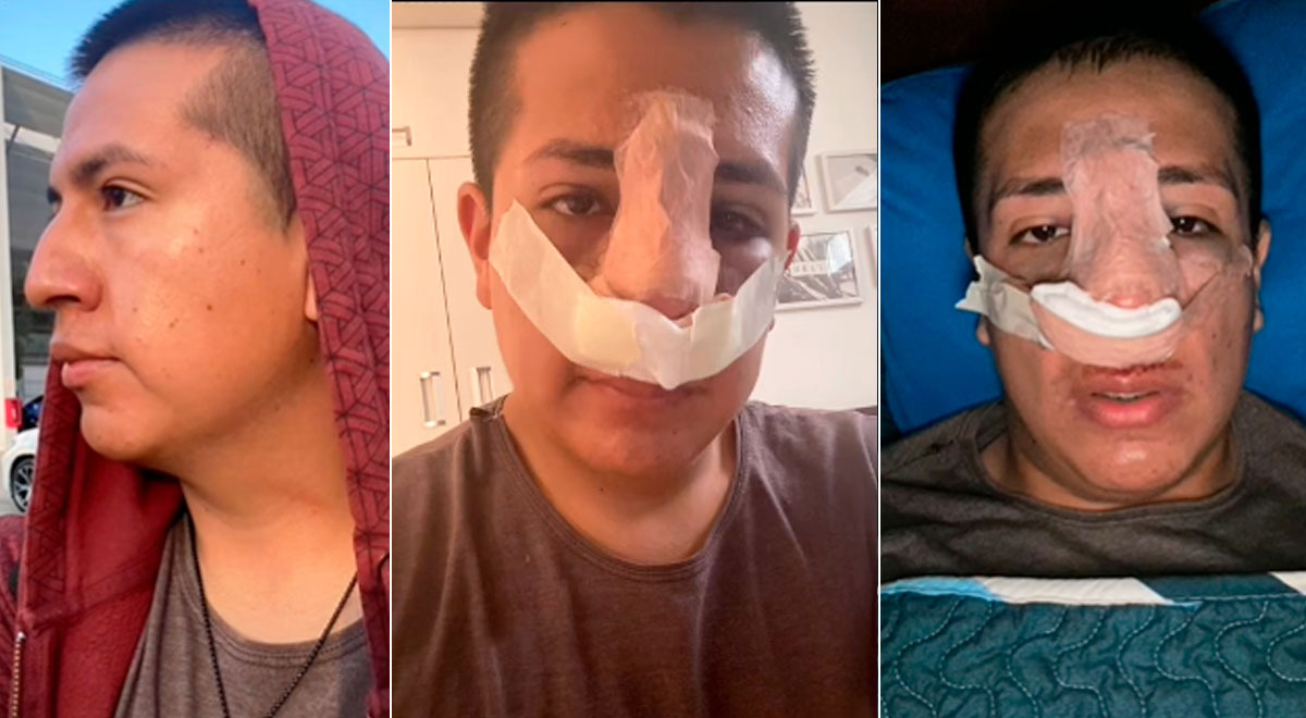 TikTok: llegó a Lima para operarse la nariz y el resultado dejó a todos en shock
