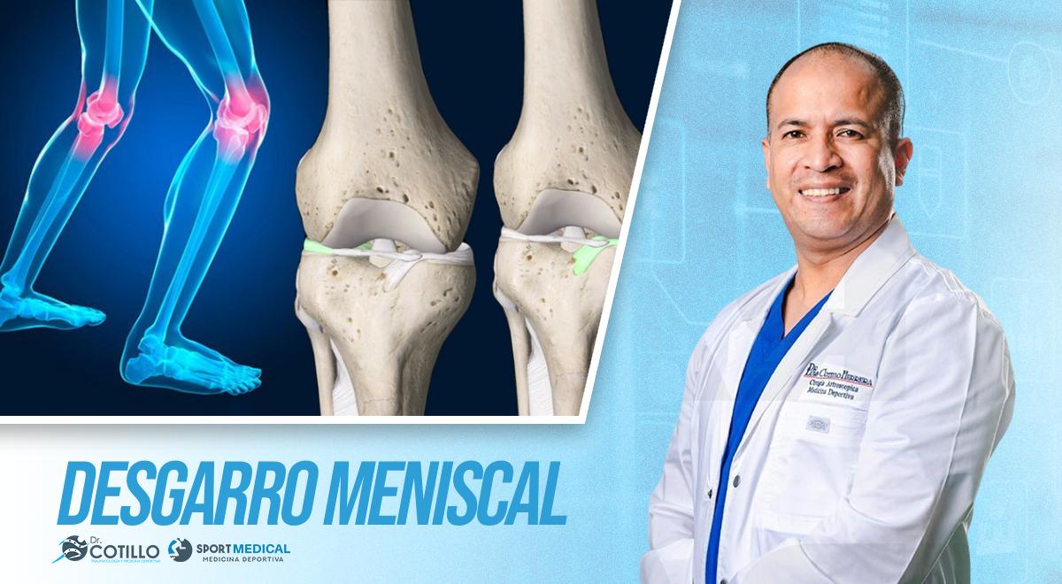 ¿Cómo sé que tengo un desgarro meniscal?, por el Dr. Cotillo