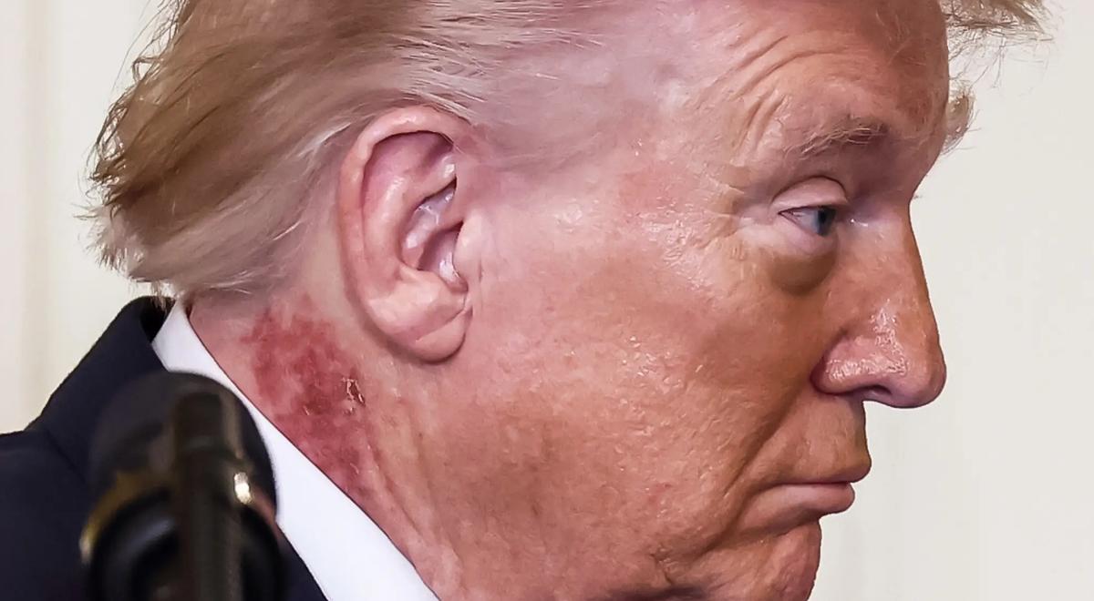 ¿Por qué Donald Trump tiene una mancha roja en el cuello? Su médico aclara si peligra su salud