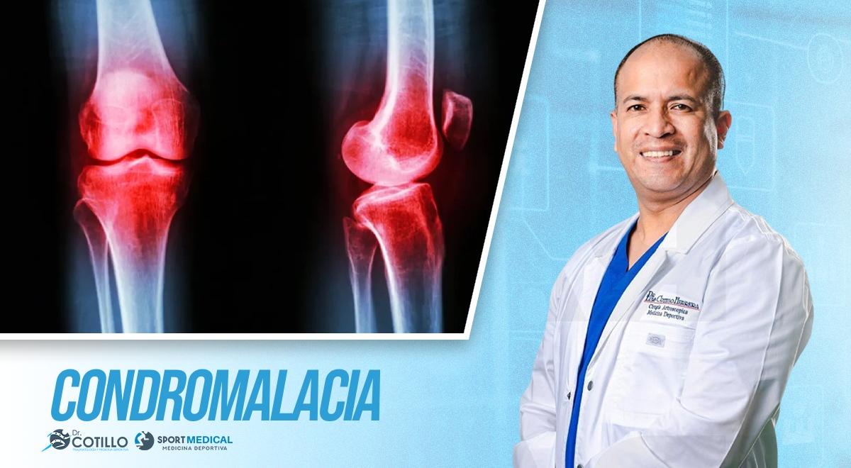 Si tienes condromalacia, ¿debes guardar reposo absoluto?