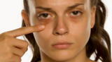 Existen diferentes alternativas para reducir la hinchazón y coloración que se produce alrededor de los ojos.