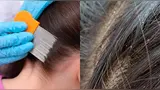 Suben los contagios de piojos en estudiantes de EE.UU.