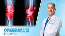 Si tienes condromalacia, ¿debes guardar reposo absoluto?