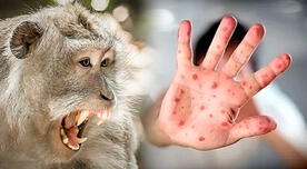 Viruela del Mono en Perú: Suben a 55 el número de casos confirmados