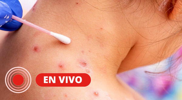 Viruela del mono: síntomas, cómo se contagia y ÚLTIMA HORA de los casos en el mundo, EN VIVO