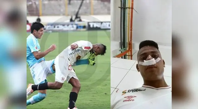 Universitario: Diego Chávez mostró como quedó su rostro tras golpe de Alexis Cossio 