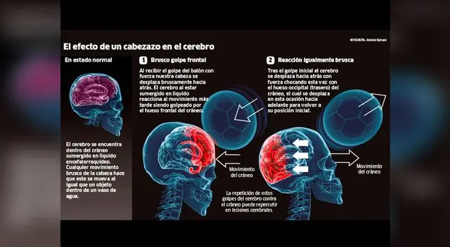 Si el balón golpea brusca y sorpresivamente al jugador, sí podría causar lesiones neurológicas. 