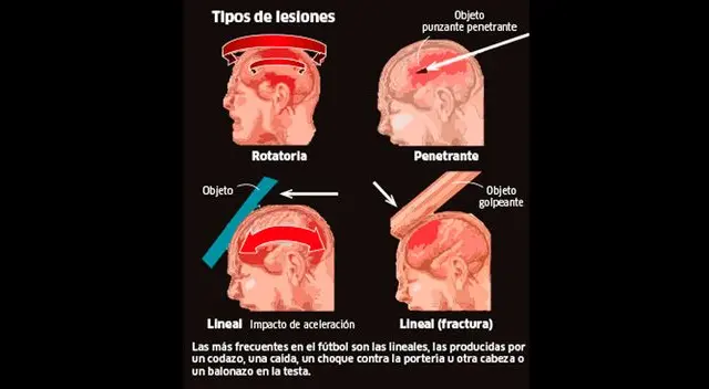Estas son las cuatro lesiones que puede sufrir un futbolista por recibir un fuerte impacto en la cabeza.