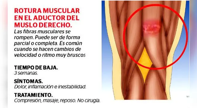 Lionel Messi: ¿Qué tan grave es la lesión que sufrió la 'Pulga'? Lionel Messi: ¿Qué tan grave es la lesión que sufrió la 'Pulga'?