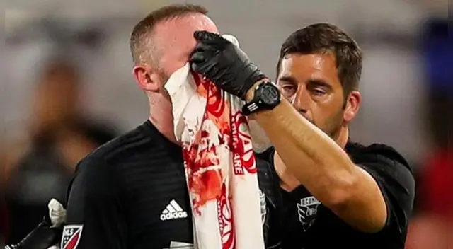 MLS: Wayne Rooney terminó ensangrentado luego de anotar su primer gol con el DC United MLS: Wayne Rooney terminó ensangrentado luego de anotar su primer gol con el DC United