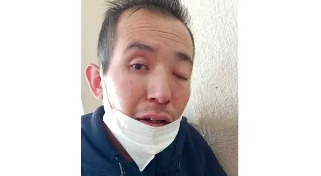 Muere Gregorio, presunto caso de hongo negro en México