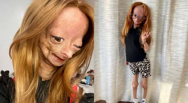 Fallece Adalia Rose, youtuber de 15 años que inspiró película de “El curioso caso de Benjamin Button”