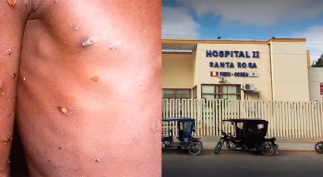 El posible caso se encuentra en Hospital II-2 Santa Rosa de Piura. El posible caso se encuentra en Hospital II-2 Santa Rosa de Piura.