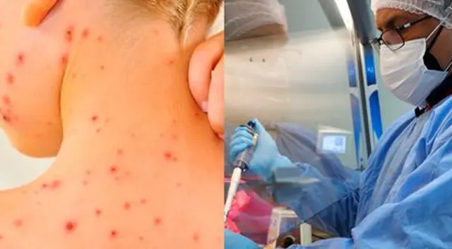 Conoce cómo se contagia la viruela de mono en Perú. Conoce cómo se contagia la viruela de mono en Perú.