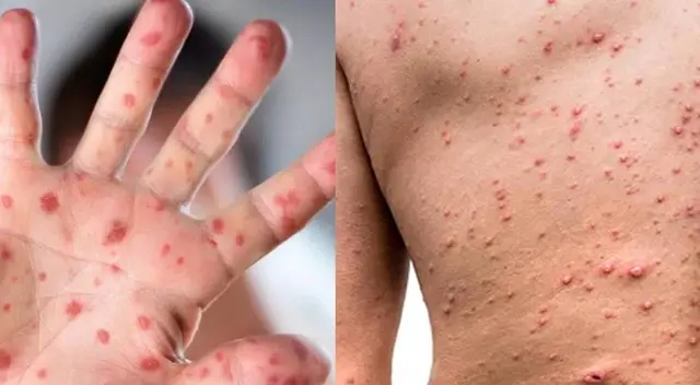 Viruela del mono: Línea 113 atendió más de 20 mil llamadas sobre posibles casos Viruela del mono: Línea 113 atendió más de 20 mil llamadas sobre posibles casos
