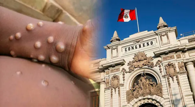 Viruela del Mono en Perú: Confirman caso positivo de un trabajador del Congreso