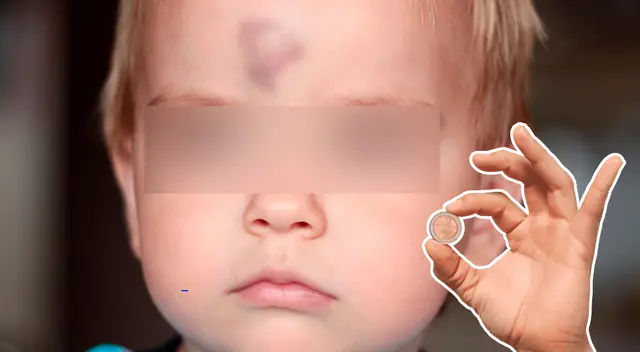 Conoce si realmente funciona colocar una moneda sobre un chichón en la cabeza. Conoce si realmente funciona colocar una moneda sobre un chichón en la cabeza.