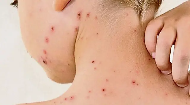 Viruela del mono en Perú: contacto sexual sería la principal vía de contagio, según INS Viruela del mono en Perú: contacto sexual sería la principal vía de contagio, según INS