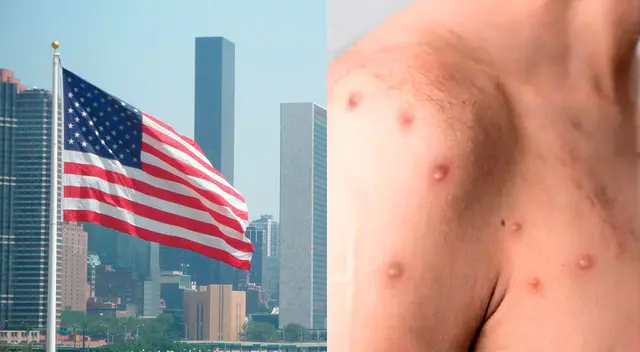 Estados Unidos registra, hasta el momento, 7.000 casos de viruela del mono. Estados Unidos registra, hasta el momento, 7.000 casos de viruela del mono.