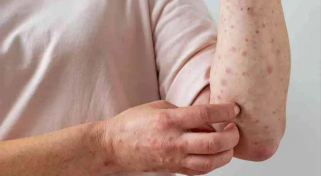 Viruela del mono: El Perú es el país con más casos confirmados en todo el mundo Viruela del mono: El Perú es el país con más casos confirmados en todo el mundo