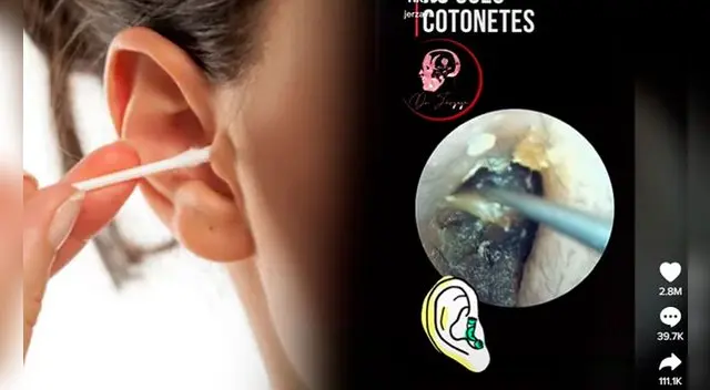 TikTok: usó hisopo toda su vida, fue al doctor y le encontraron de todo en el oído