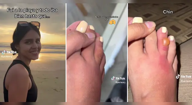 Joven se hace viral tras ser picada por extraño parásito en plena caminata por la playa