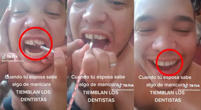 Hombre 'arregla' su diente con acrílico de manicura Hombre 'arregla' su diente con acrílico de manicura