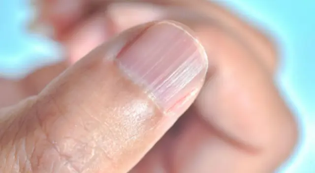 Conoce las causas de las líneas en las uñas y cuáles son las soluciones recomendadas por especialistas. Conoce las causas de las líneas en las uñas y cuáles son las soluciones recomendadas por especialistas.