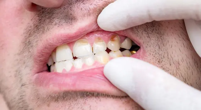 Erradica esta enfermedad de tus dientes gracias al consumo de una fruta muy deliciosa.