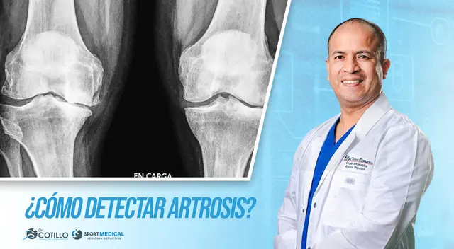 Signos para detectar la artrosis, según el doctor Luis Cotillo Signos para detectar la artrosis, según el doctor Luis Cotillo