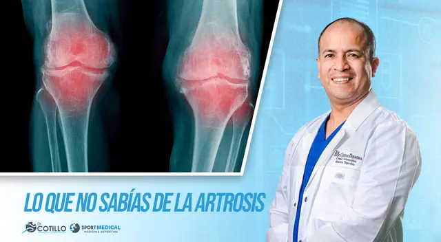 ¿Qué articulaciones son las más afectadas por la artrosis?, por el Dr. Luis Cotillo ¿Qué articulaciones son las más afectadas por la artrosis?, por el Dr. Luis Cotillo