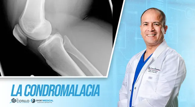 ¿La condromalacia puede ser diagnosticada por un fisioterapeuta? ¿La condromalacia puede ser diagnosticada por un fisioterapeuta?