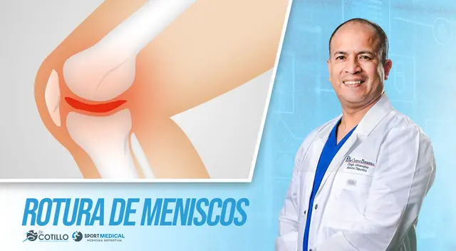 ¿Cómo saber si te rompiste el menisco?, por el Dr. Cotillo ¿Cómo saber si te rompiste el menisco?, por el Dr. Cotillo