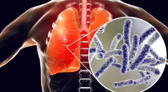 Legionella Legionella