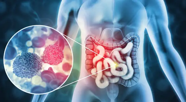 La mortalidad por cáncer baja en jóvenes