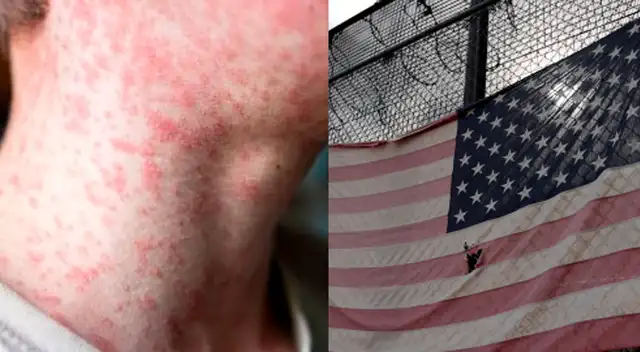 Brote de sarampión EE. UU.