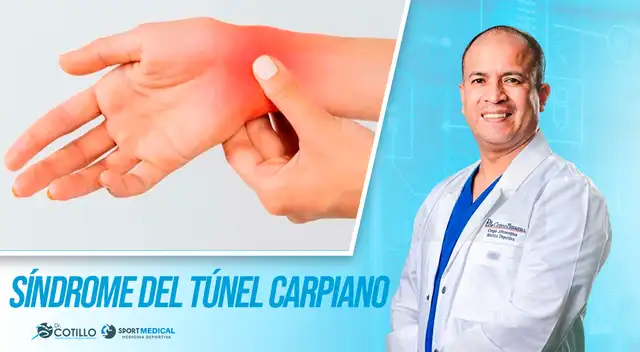 Síndrome del túnel carpiano