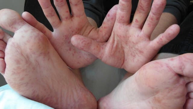Conoce cuáles son los síntomas del virus Coxsackie y donde se han registrado en el Perú Conoce cuáles son los síntomas del virus Coxsackie y donde se han registrado en el Perú