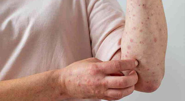 Viruela del mono: El Perú es el país con más casos confirmados en todo el mundo
