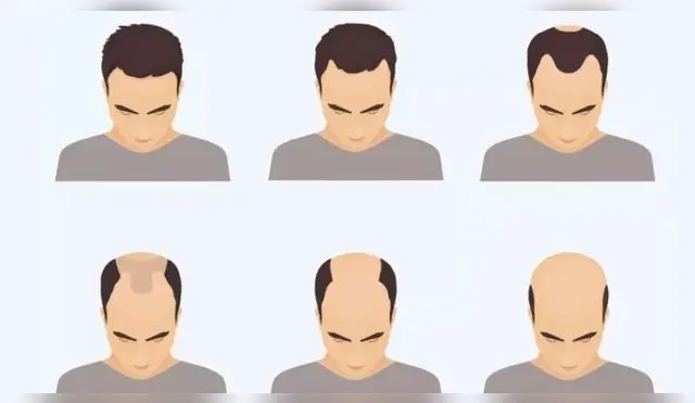La pérdida de cabello es uno de los problemas más comunes en los últimos años.